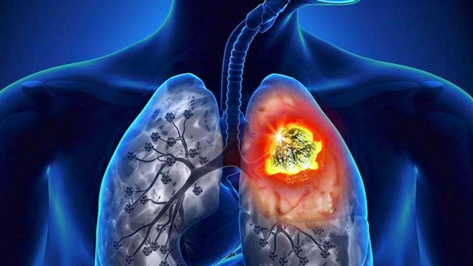 Isabel Rangel Baron - Cancer de pulmon