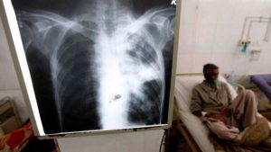OPS alerta sobre avance silencioso de la tuberculosis en las Américas