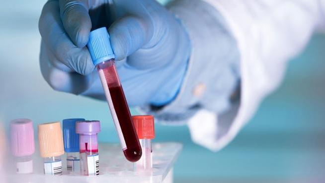 Test de sangre determina si hay riesgo de Alzheimer