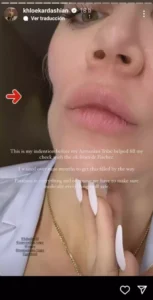 Khloé Kardashian muestra el antes y después del tumor en su rostro ????????