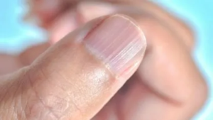 Las famosas rayas en las uñas: ¿Por qué aparecen?