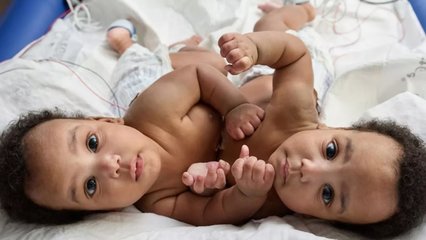 Tras casi un año los gemelos siameses fueron separados