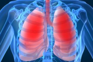 Creyó que estaba enfermo de cáncer, pero descubrieron que hacía 40 años tenía un juguete en el pulmón