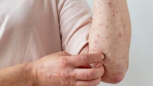 Dos estados reportaron casos de sarampión en medio de preocupante brote