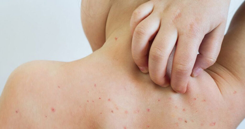 OPS alerta por brote de sarampión en las Américas