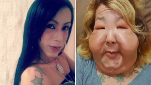 Una influencer inició un tratamiento de recuperación tras un procedimiento estético que la dejó desfigurada