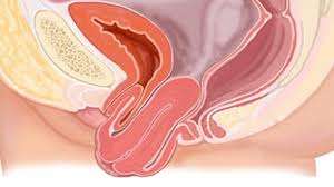 Prolapso de órganos pélvicos: una enfermedad silenciosa y frecuente